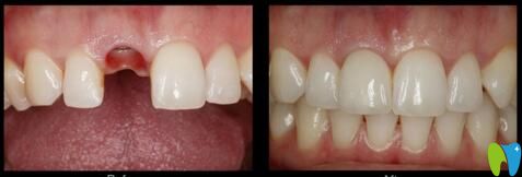 朝陽(yáng)牙博士牙齒缺失種植效果 朝陽(yáng)牙博士牙齒缺失種植效果