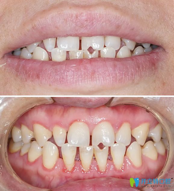 遵義華美口腔3D牙貼面前牙齒照片
