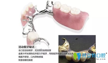 活動(dòng)假牙的缺點(diǎn)介紹