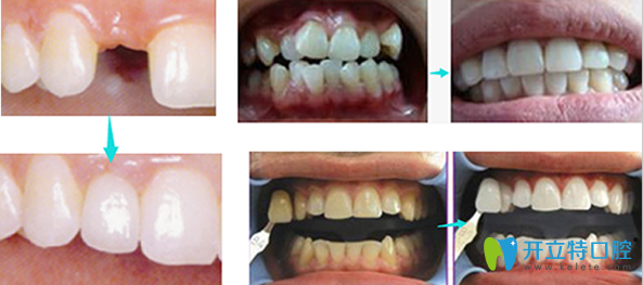   龍巖萬翔口腔種植牙、牙齒矯正和牙齒美白效果對比圖
