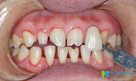遵義華美牙齒貼面制作前基牙色比色