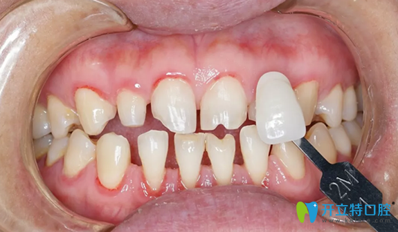 3D牙貼面制作前目標(biāo)色比色