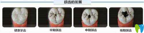 兒童牙齒齲發(fā)展階段 兒童牙齒齲發(fā)展階段