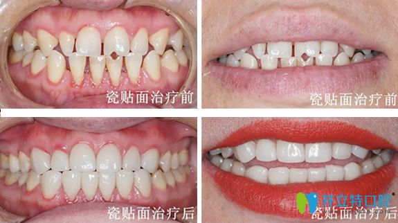 遵義華美口腔3D牙齒貼面治療前后對比照片