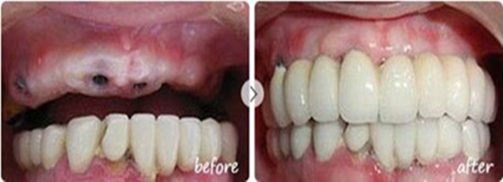 在汕頭芽芽口腔做牙缺失種植修復，是我做過較理智的選擇