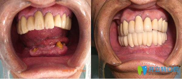 在唐山拜博口腔種植牙前后對(duì)比