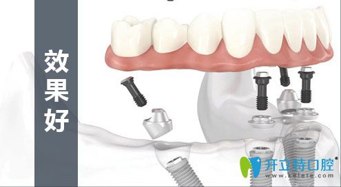 all-on-4種植技術(shù)效果 all-on-4種植技術(shù)效果