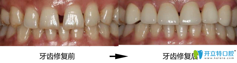 潮州眾信牙齒修復(fù)效果怎么樣 潮州眾信牙齒修復(fù)效果怎么樣