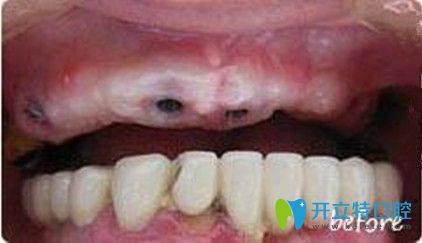 牙齒缺失術前照