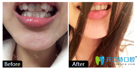 廣州柏德口腔牙齒矯正案例對比圖 廣州柏德口腔牙齒矯正案例對比圖