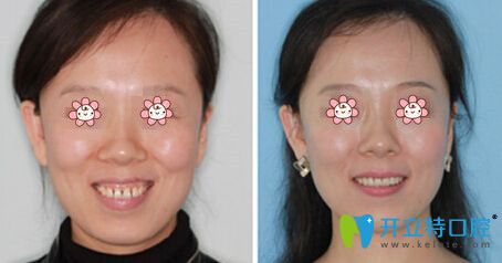 周長松院長牙齒正畸案例 周長松院長牙齒正畸案例