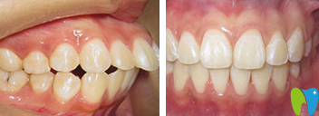 濰坊可恩口腔魏奉才上頜矯正效果對比圖 濰坊可恩口腔魏奉才上頜矯正效果對比圖