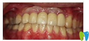 治療后口內(nèi)照