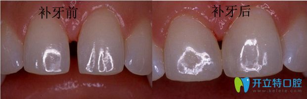 潮州眾信補(bǔ)牙真人案例效果對(duì)比 潮州眾信補(bǔ)牙真人案例效果對(duì)比