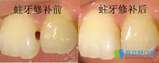 潮州眾信蛀牙修補(bǔ)前后對(duì)比 潮州眾信蛀牙修補(bǔ)前后對(duì)比