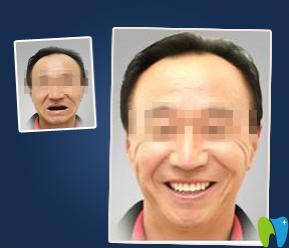 可恩口腔種植牙效果對比圖