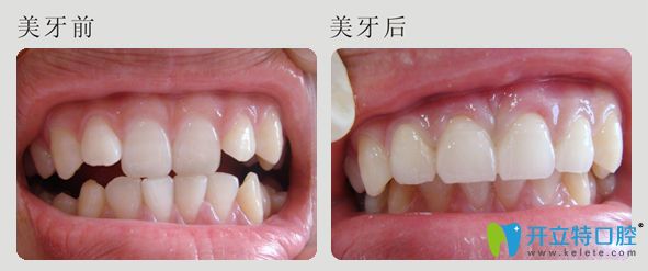 潮州眾信牙科美牙前后效果對(duì)比 潮州眾信牙科美牙前后效果對(duì)比