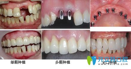 長春現(xiàn)代口腔種植牙案例