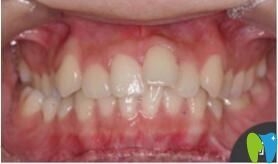 <!--<i data=20240703-sp></i>-->口腔張瓊牙齒矯正真人案例術(shù)前照