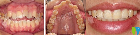 華貝口腔牙齒矯正術前術后效果圖