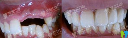 濰坊華貝種植牙效果對比圖