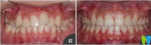 <!--<i data=20240703-sp></i>-->口腔張瓊牙齒矯正真人案例效果對(duì)比