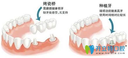 種植牙和鑲牙哪個壽命更長