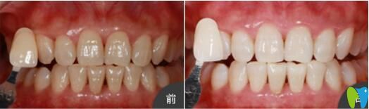 <!--<i data=20240703-sp></i>-->口腔美容冷光牙齒美白真人案例前后效果是對(duì)比圖
