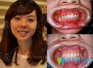 20180622973307.jpg EMS牙周綜合治療真人案例.jpg