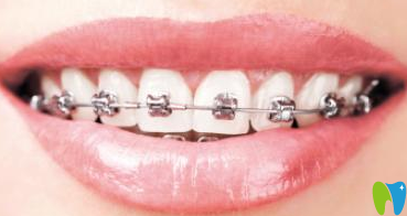 寧波牙博士口腔金屬托槽矯正器