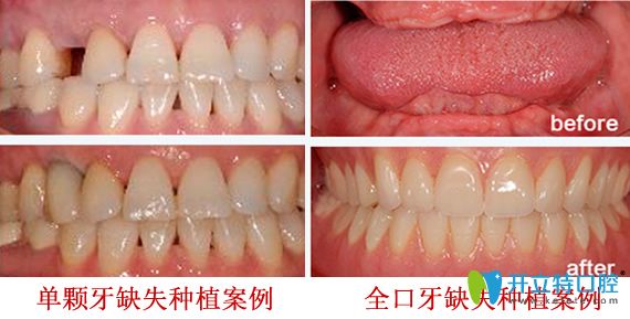 深圳拜博口腔好不好？深圳拜博口腔牙齒種植案例效果來證明實力