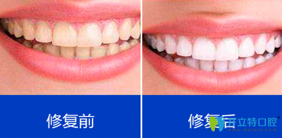 深圳拜博口腔靠譜不？氟斑牙全瓷牙貼面修復(fù)案例效果來證明