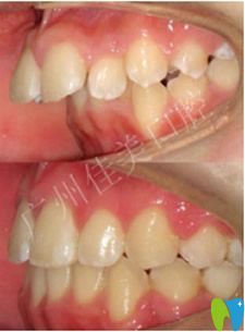 佳美口腔齙牙矯正真人案例 佳美口腔齙牙矯正真人案例