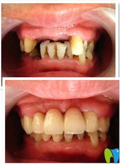 威海舒好王醫(yī)生牙體缺失修復(fù)案例對比圖