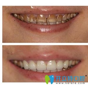 威海舒好口腔王勛醫(yī)生四環(huán)素牙案例對比圖