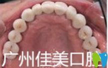 佳美口腔半口牙種植效果 佳美口腔半口牙種植效果