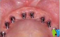 種植牙齒前先讓種植體固定在牙槽骨內(nèi) 種植牙齒前先讓種植體固定在牙槽骨內(nèi)