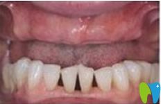 廣州佳美口腔牙齒種植前 廣州佳美口腔牙齒種植前