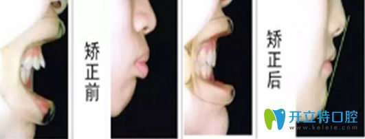 太平洋口腔牙齒矯正前后對比圖