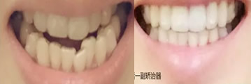 牙齒矯正要多久？90后美女用10個(gè)月完成牙齒正畸的真實(shí)經(jīng)歷