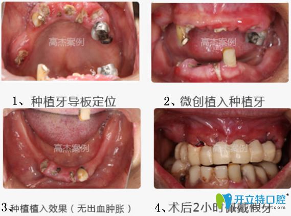 <!--<i data=20240703-sp></i>-->齒科上半口牙缺失患者修復案例