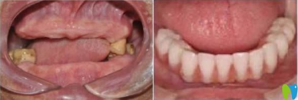 全口牙缺失怎么辦？合肥美奧口腔全口種植牙案例效果賞析