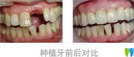 青島可恩口腔種植牙前后效果對(duì)比圖