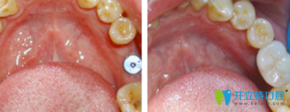 諾德齒科張榮水院長(zhǎng)牙齒種植精品案例