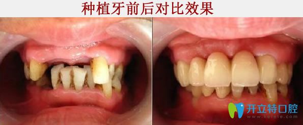 <!--<i data=20240703-sp></i>-->牙科種植牙前后對比照 <!--<i data=20240703-sp></i>-->牙科種植牙前后對比照