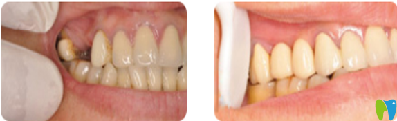 深圳諾德口腔怎么樣？諾德齒科種植牙案例前后對比圖