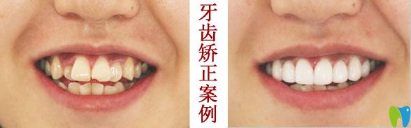 <!--<i data=20240703-sp></i>-->牙齒矯正前后對比效果 <!--<i data=20240703-sp></i>-->牙齒矯正前后對比效果