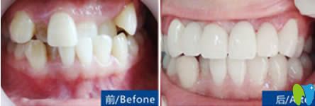 深圳拜博金屬牙齒矯正前對比照