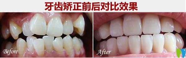 28歲顧客時(shí)代天使矯正前后對(duì)比照