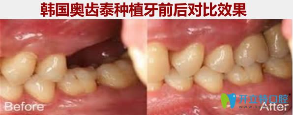 韓國奧齒泰種植牙前后對(duì)比照片